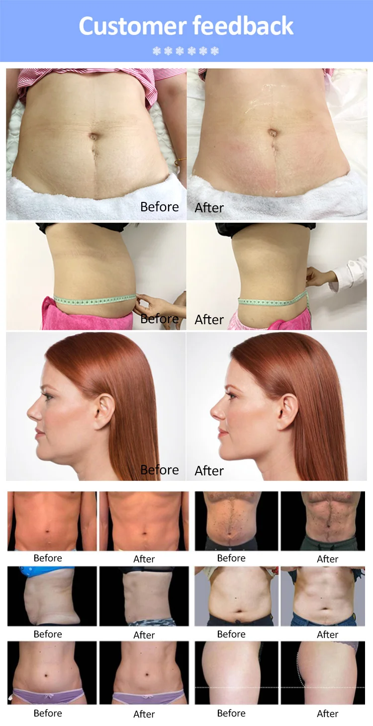 3 cryo handles maquinas reductoras de abdomen slimming cold body sculpting criolipolisis fat freeze cryolipolysis equipment